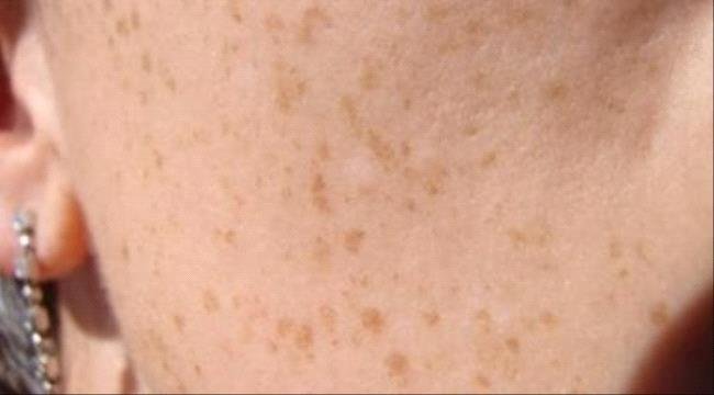 ما الأسباب الرئيسية وراء ظهور بقع في الجلد.. تعرف عليها ما الأسباب الرئيسية وراء ظهور بقع في الجلد تعرف عليها